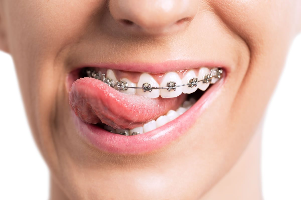 Orthodontics are fun